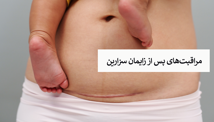 مراقبتهای پس از زایمان سزارین